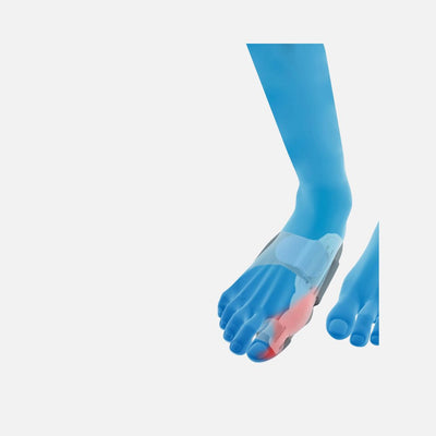 TYNOR CURE BUNION SPLINT